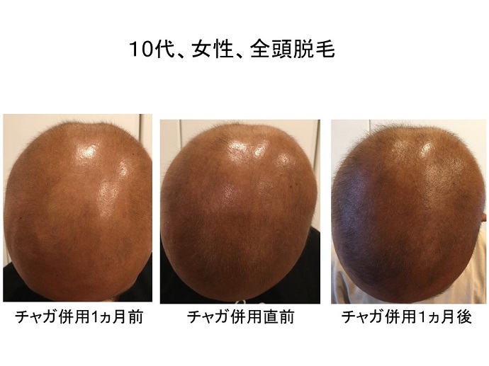 円形脱毛症　病院